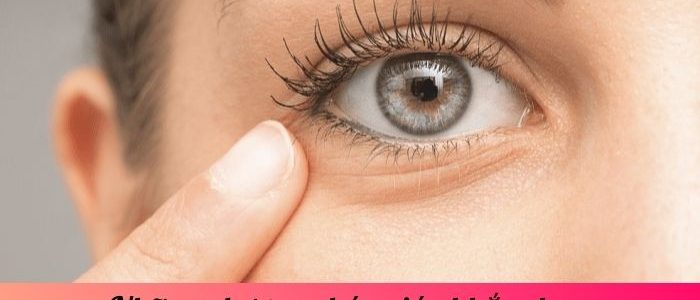 Những phương pháp giúp khắc phục vết chân chim ở mắt hiệu quả