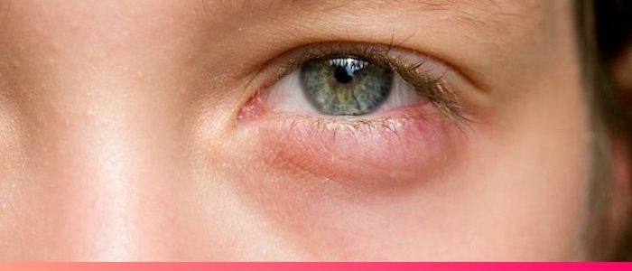 Đau mí mắt dưới nguyên nhân do đâu và cách điều trị hiệu quả?